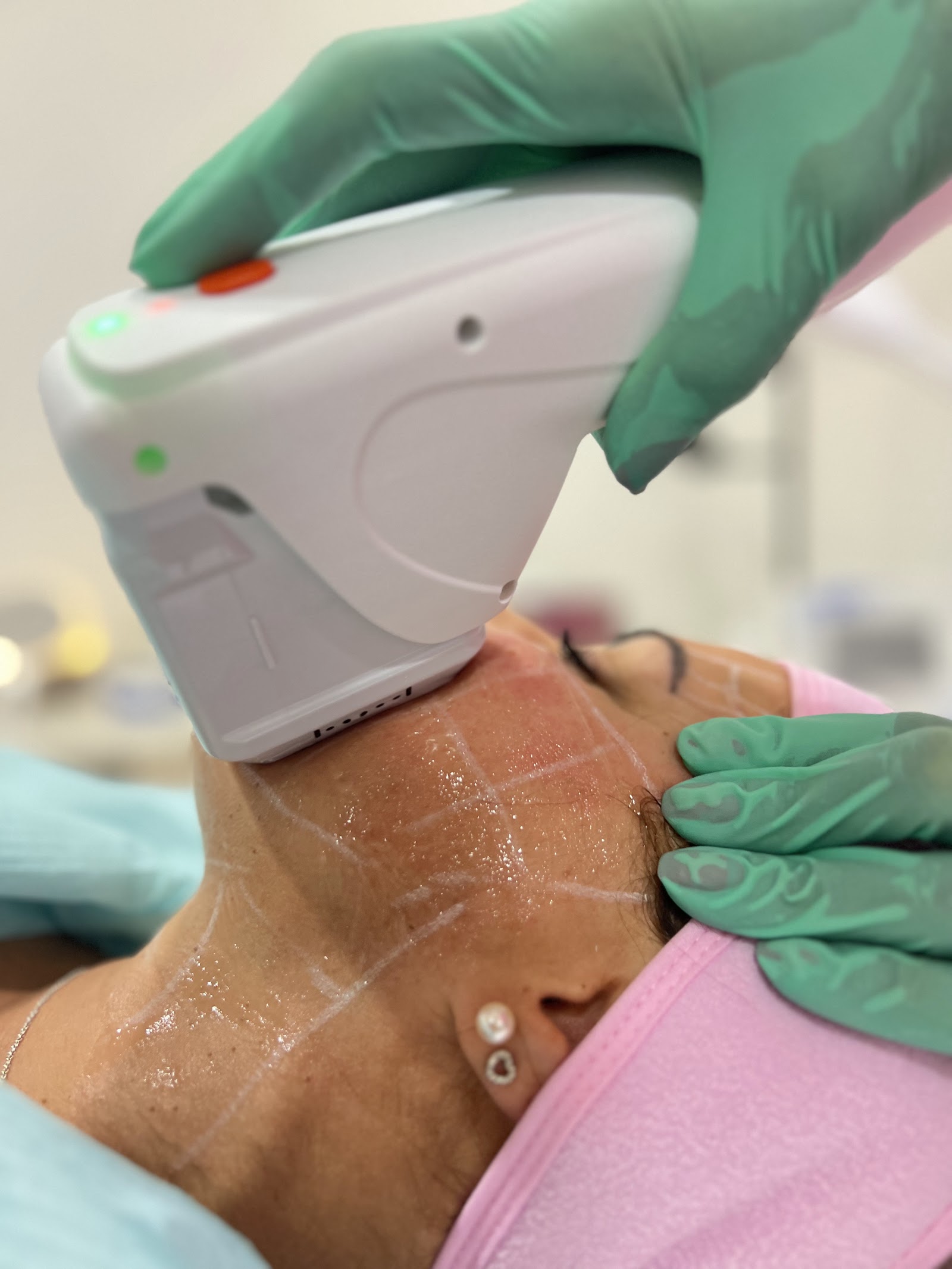 Ultrassom microfocado facial na Clínica MASO